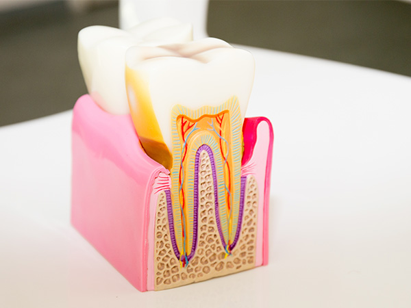 根管治療のイメージ画像